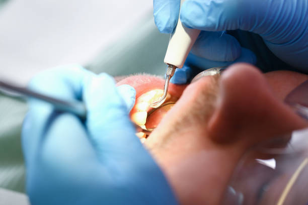 Best Emergency Root Canal Treatment in Lionville, PA